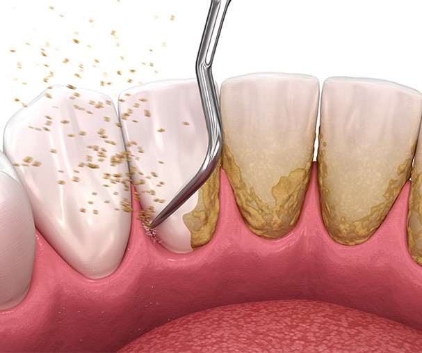 A 3D illustration of scaling and root planing